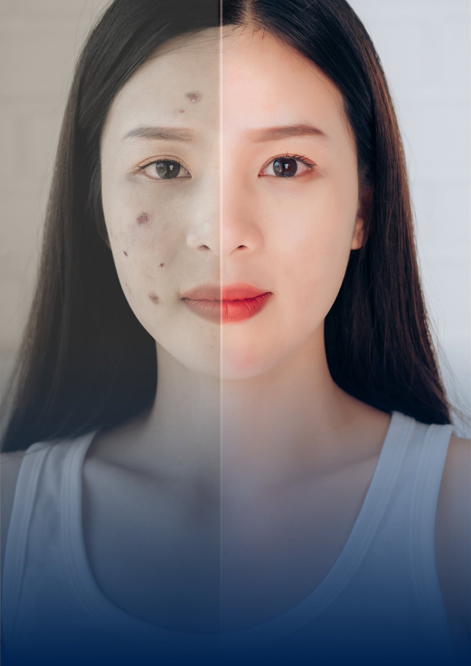 Anti-Acne